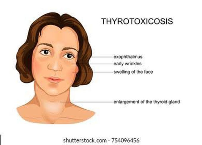 Diagnosis of thyrotoxicosis