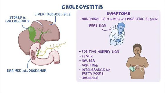 Symptoms of cholecystitis