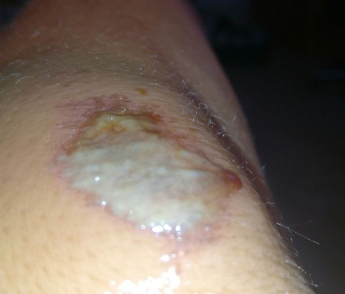Diagnosis and treatment