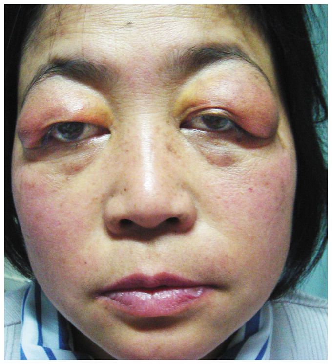 Eyelid Swelling and Primary Sjögren's Syndrome