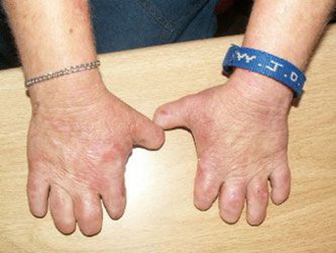 Homozygous Variegate Porphyria
