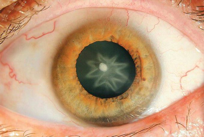 Star shaped cataract.