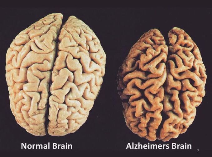 Alzheimer's disease