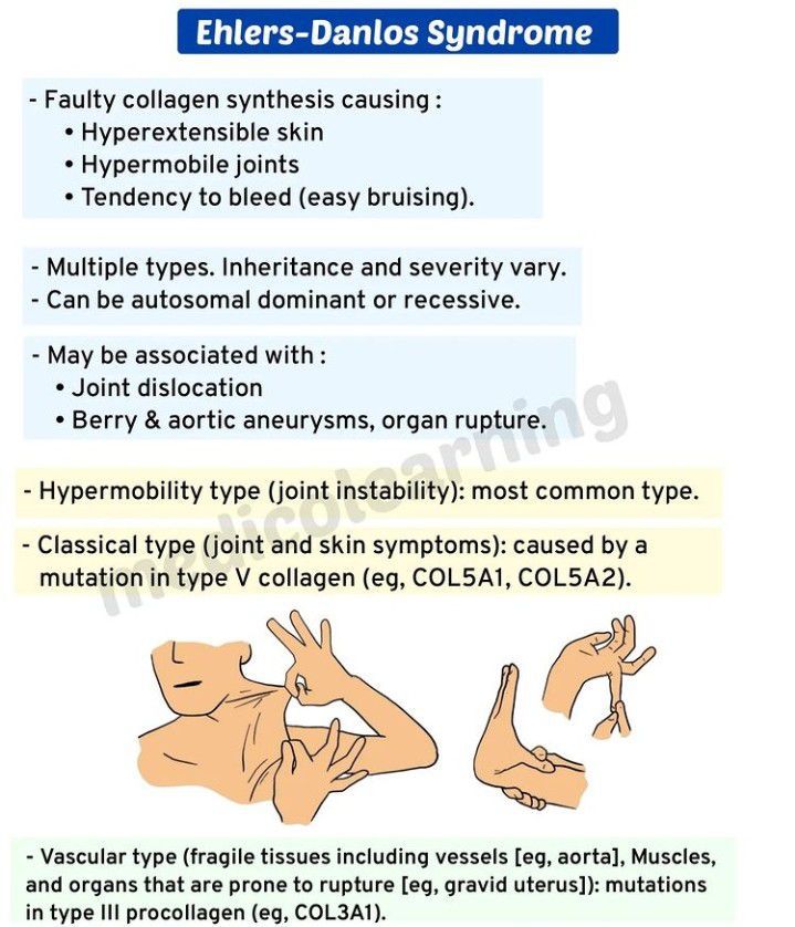 Ehler Danlos Syndrome Medizzy 3453