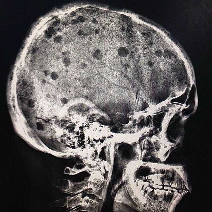 Sign?? Diagnosis??