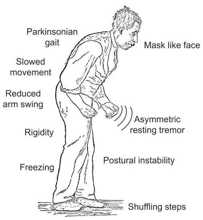 Treatment of parkinsons