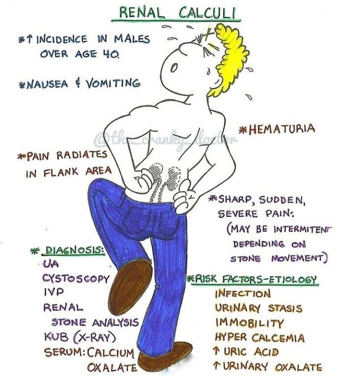 Renal calculi