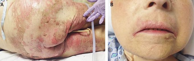 Acquired Acrodermatitis Enteropathica