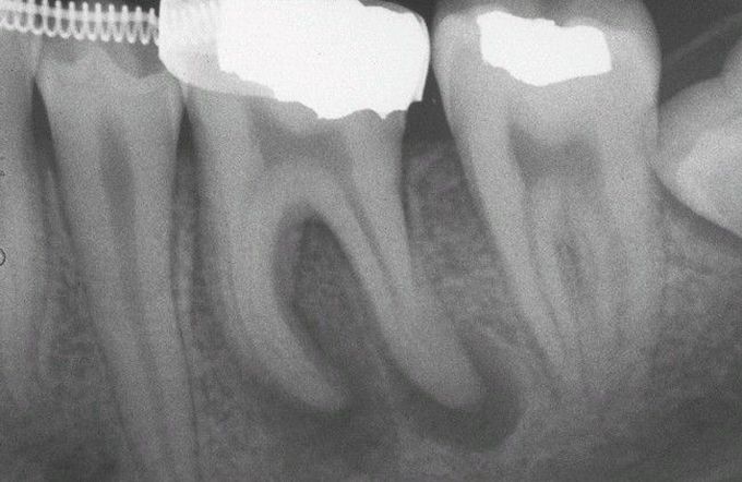 Periapical Granulomas.