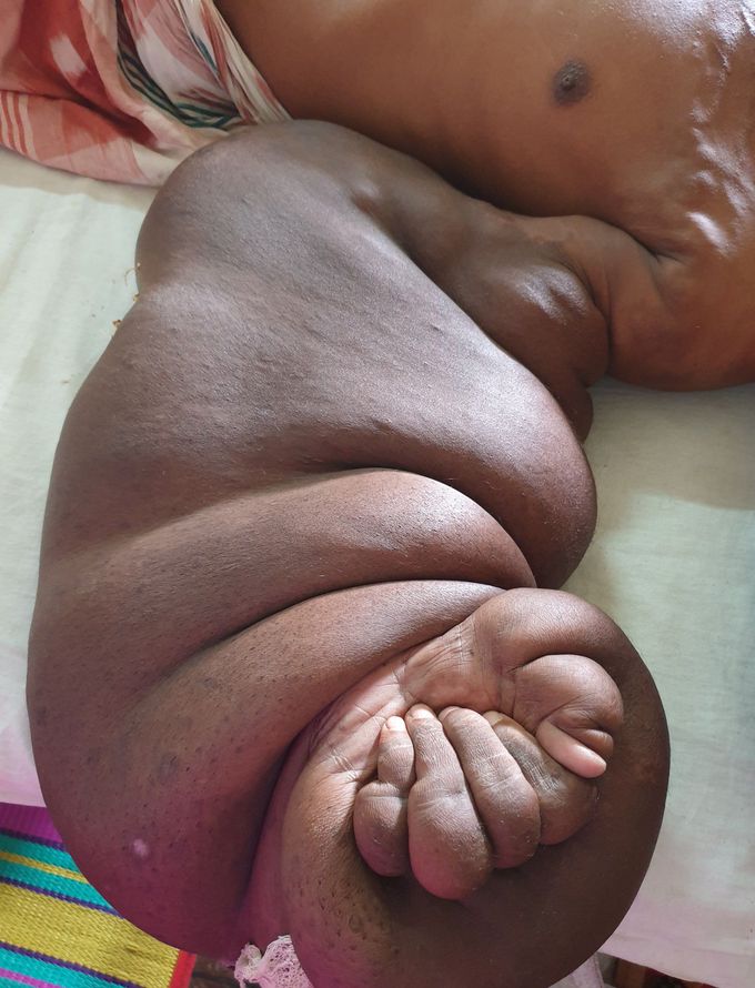 PLEXIFORM NEUROFIBROMA