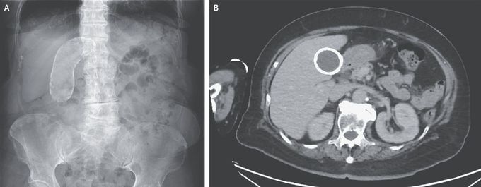 A Calcified Gallbladder