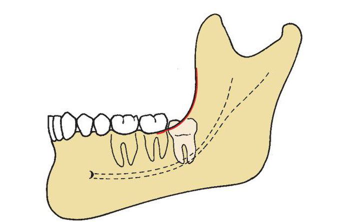 Pell and Gregory class 2 impaction