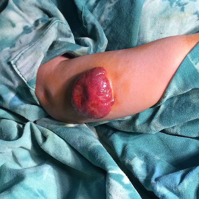 8 months old boy with hemangioma on antebrachii