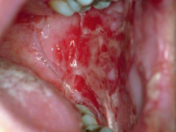Oral pemphigus vulgaris