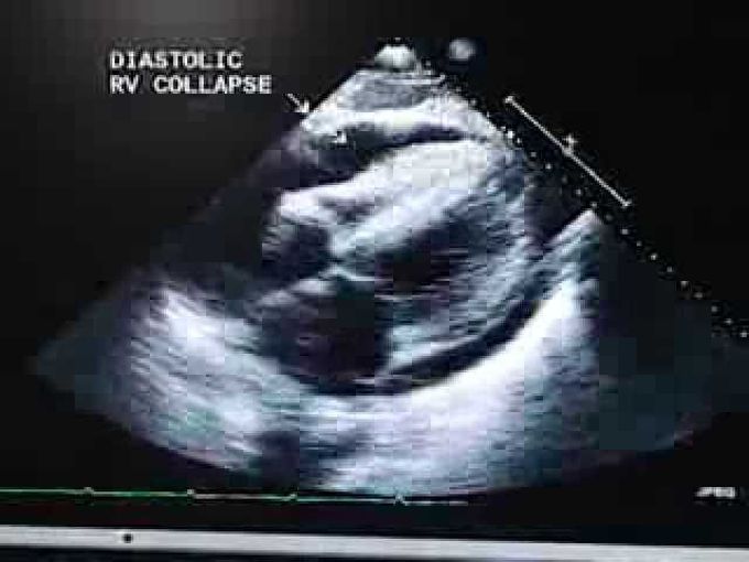 Ultrasonography of the pericardial sac- Tamponade
