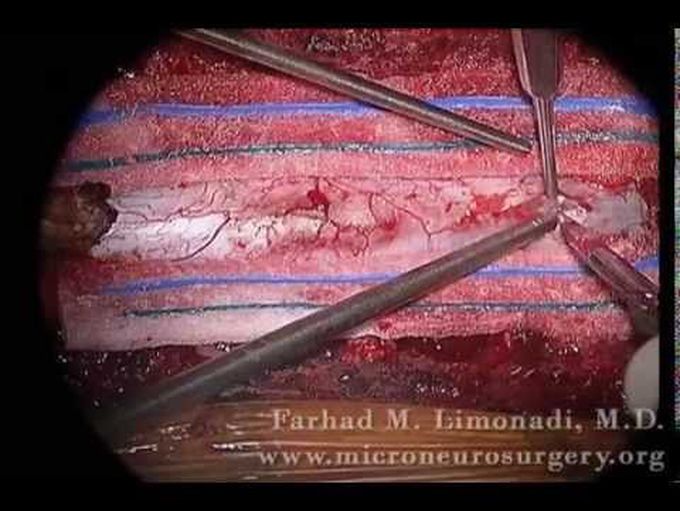 Spine Tumor Removal of Thoracic Schwannoma: Actual footage of Spine Surgery