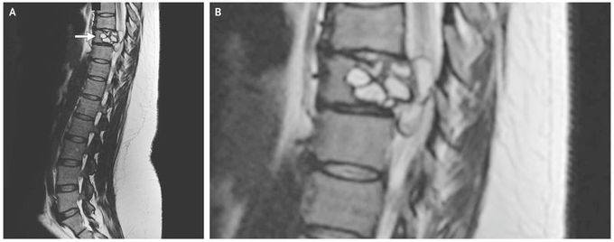 Vertebral Hydatidosis