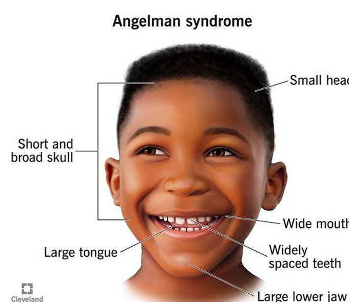 These are the symptoms of Angelman syndrome