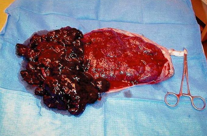 Placental abruption