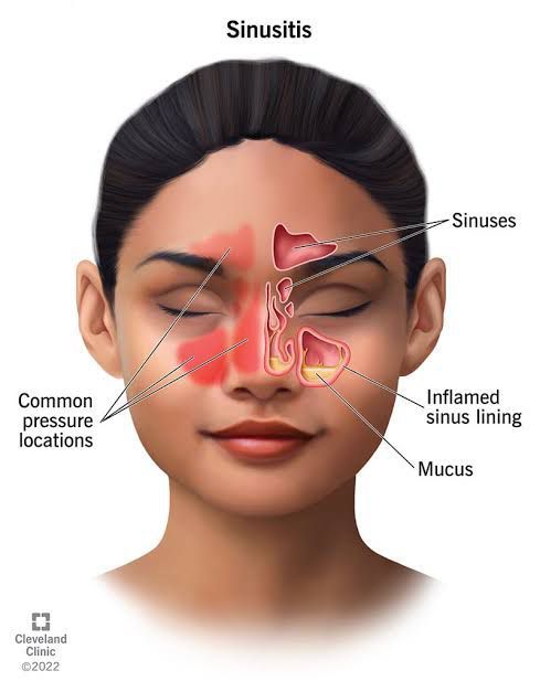 how-to-clear-seriously-blocked-sinuses-naturally-in-1-minute-with