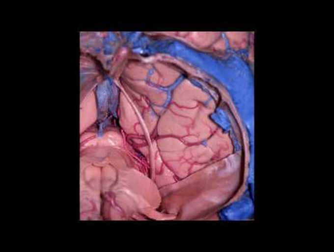 The paramedian supracerebellar-transtentorial approach to remove a posterior fusiform gyrus AVM