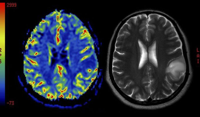The Most Common Brain Tumor: 5 Things You Should Know