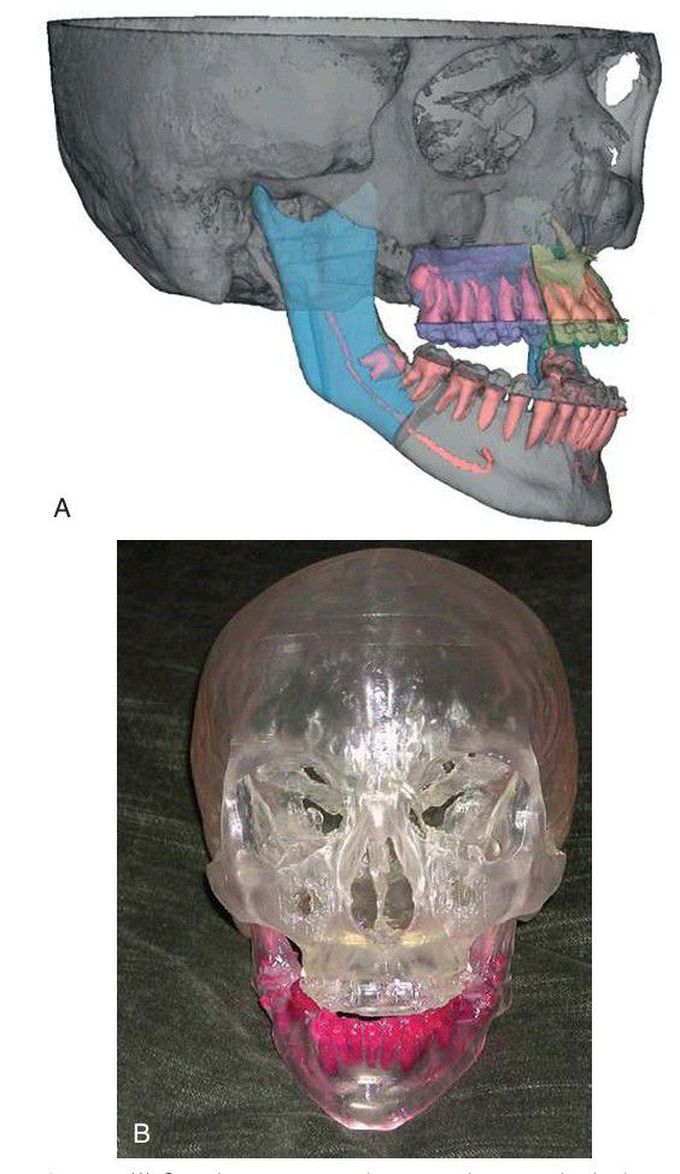 3D Imaging and Model for Mandibular Assessment