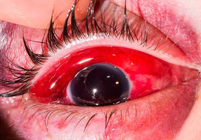 EYE TRAUMA