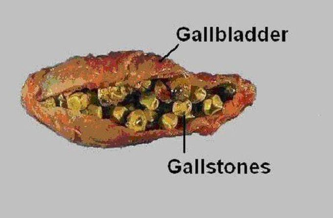 Gall stones