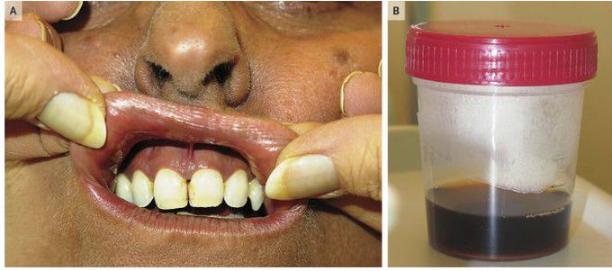 Diffuse Melanosis and Melanuria