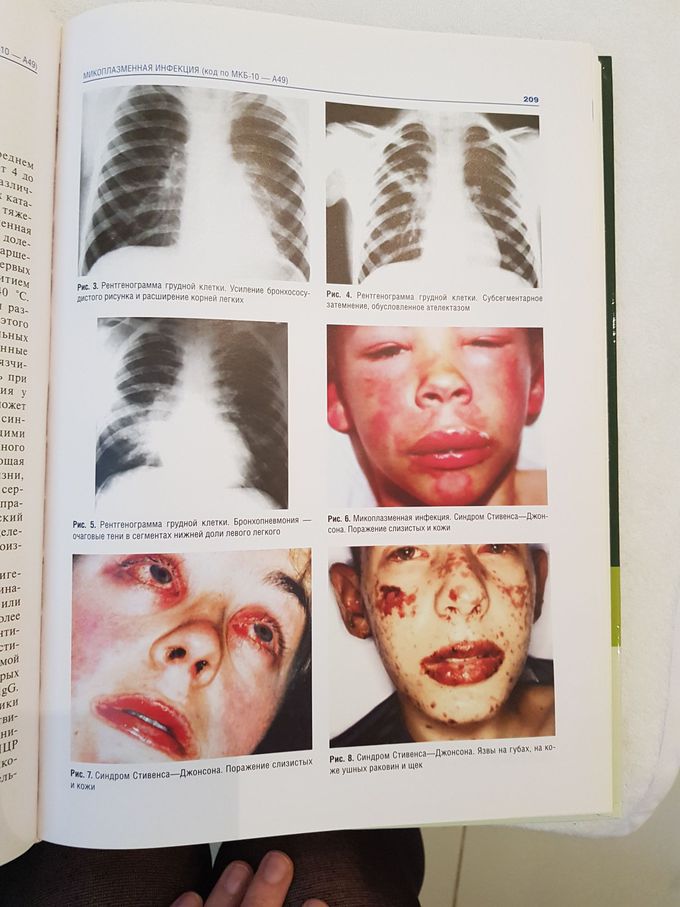 Steven Johnson Syndrome