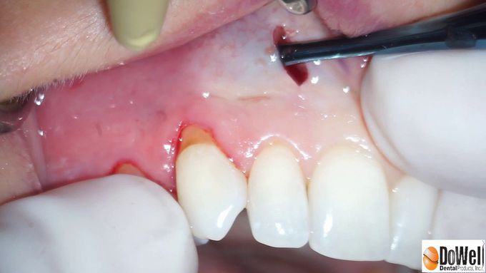 Vista and Access Piezo Surgery Video