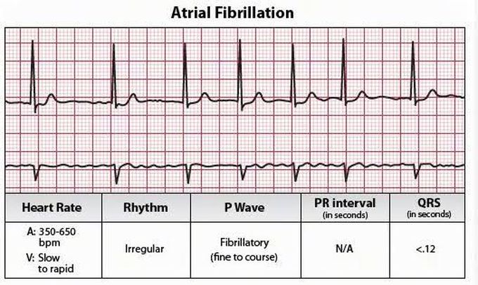 Atrial Fibrillation