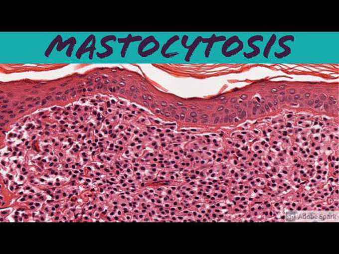 Pathology of Mastocytosis.