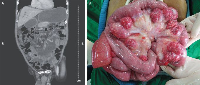 Mesenteric Volvulus