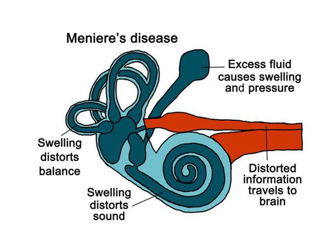 symptoms of meniere disease