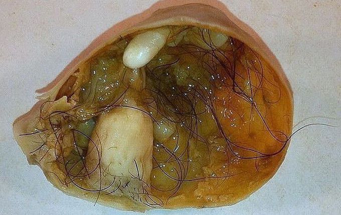 Identify the Type of Tumor