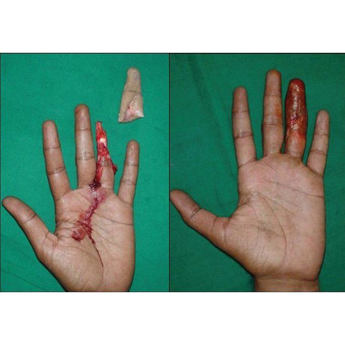 Degloving injury of the ring finger with subsequent removal of the underlying tissue