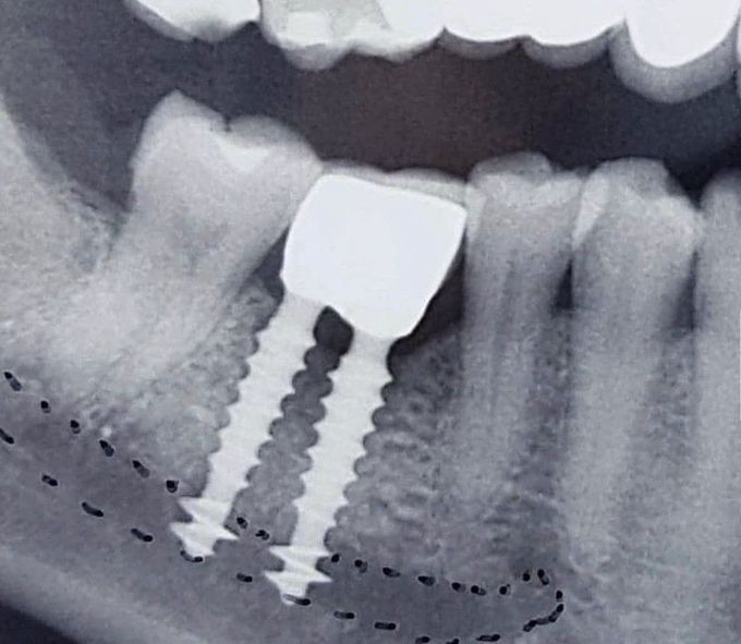 Implant Failure