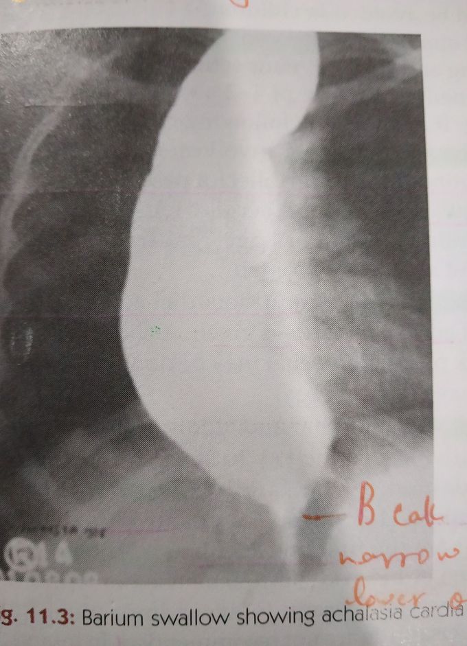 Achalasia cardia on #barium swallow