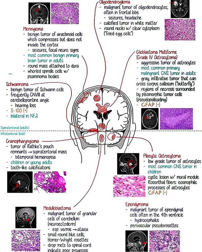 CNS tomurs