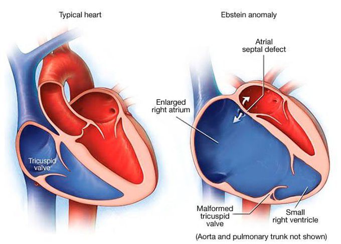 Ebstein anomaly