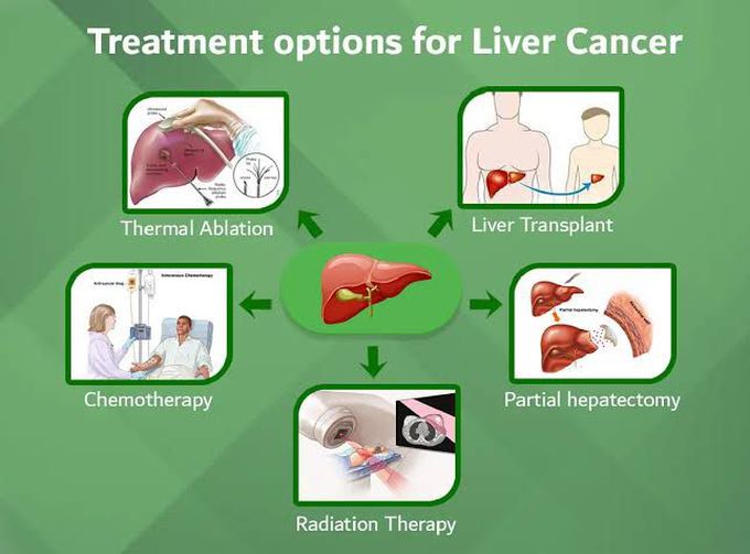 Treatment options for liver cancer