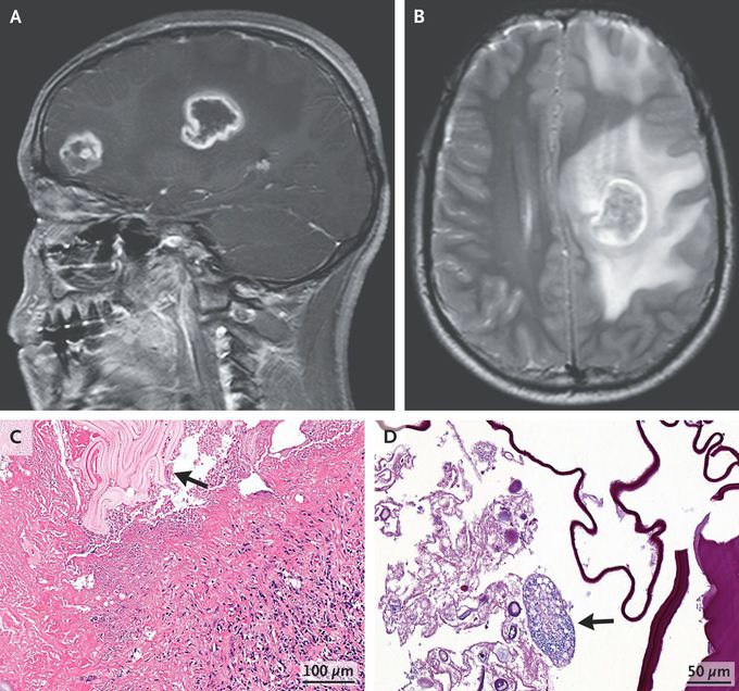 Cerebral Alveolar Echinococcosis