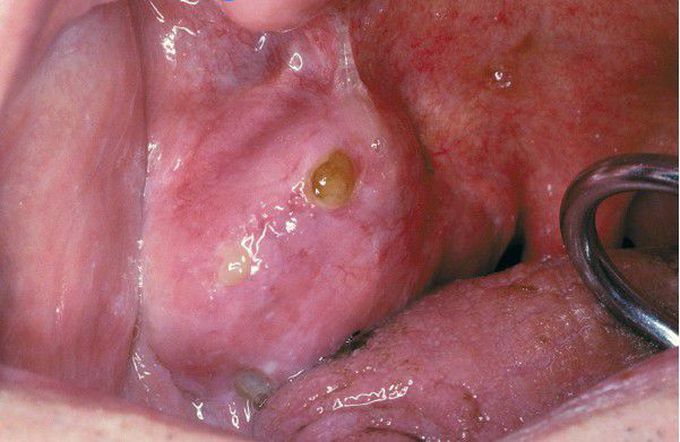 Pleomorphic Adenoma.