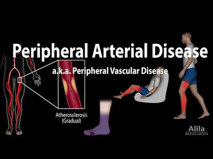 Precise explanation of peripheral artery disease (PAD)