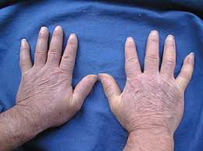 Symptoms of scleroderma