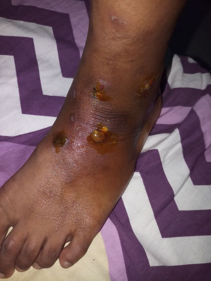 Diagnosis ?