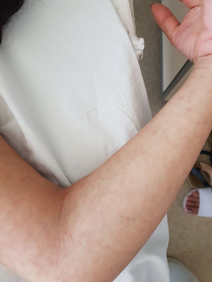 After measles hyperpigmentasion