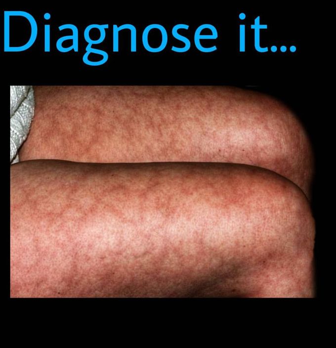 diagnosis ??